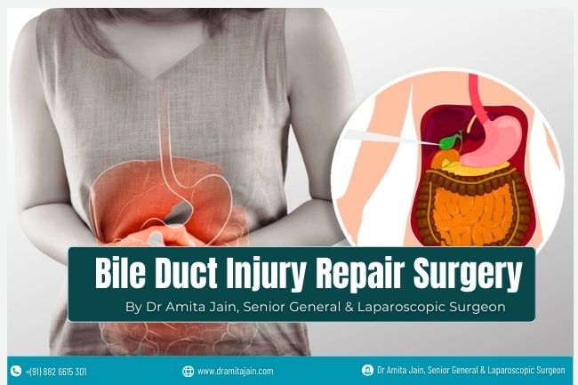 Bile Duct Injury Repair Surgery by Dr Amita Jain Bile Duct Injury Repair Surgery by Dr Amita Jain